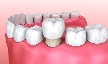 Dental crowns