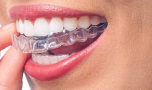 Invisalign in karachi