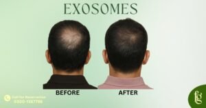 Read more about the article Best Exosome Therapy for Hair Restoration in Karachi – FG Cosmo Dental