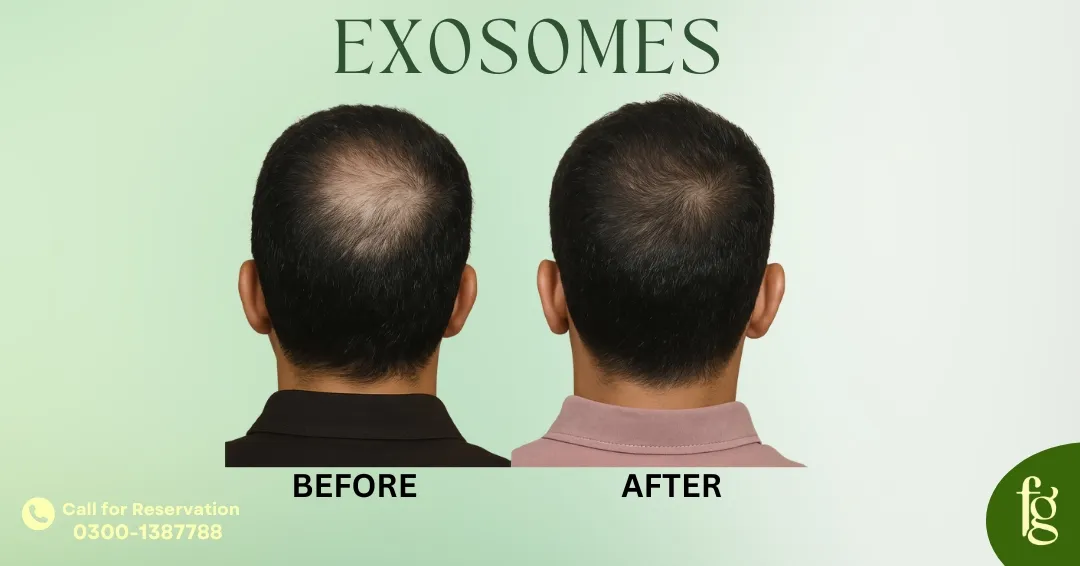 Read more about the article Best Exosome Therapy for Hair Restoration in Karachi