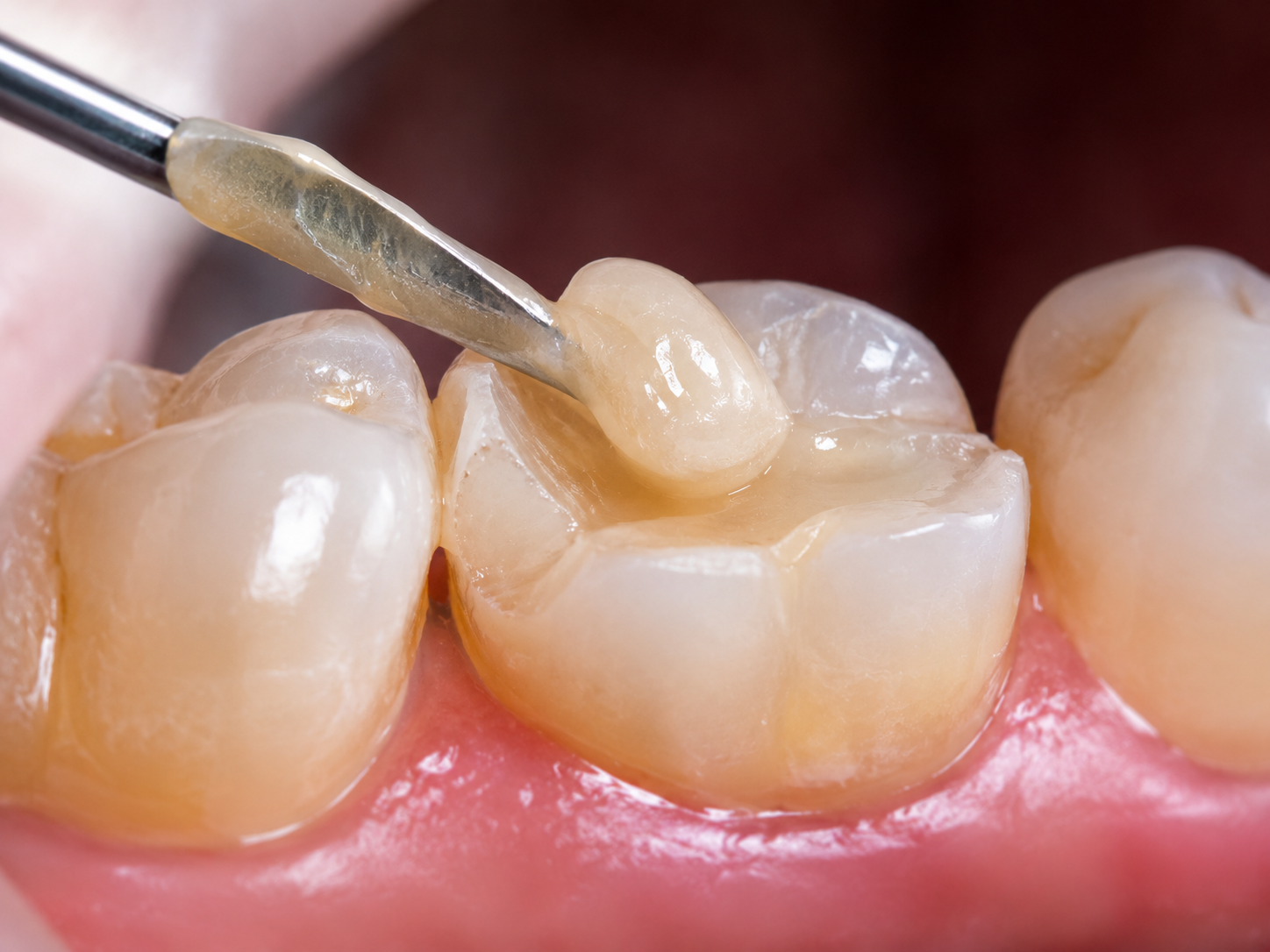 Close-up composite filling treatment in Karachi