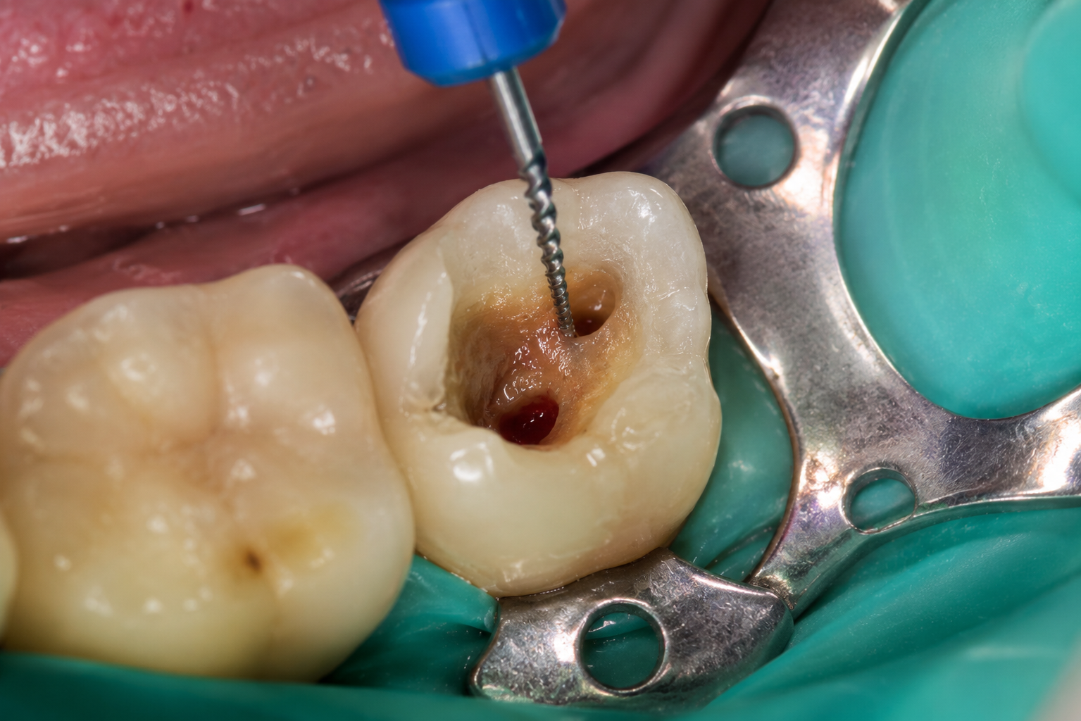Children's pulpotomy care at FG Cosmo Dental Clinic Karachi