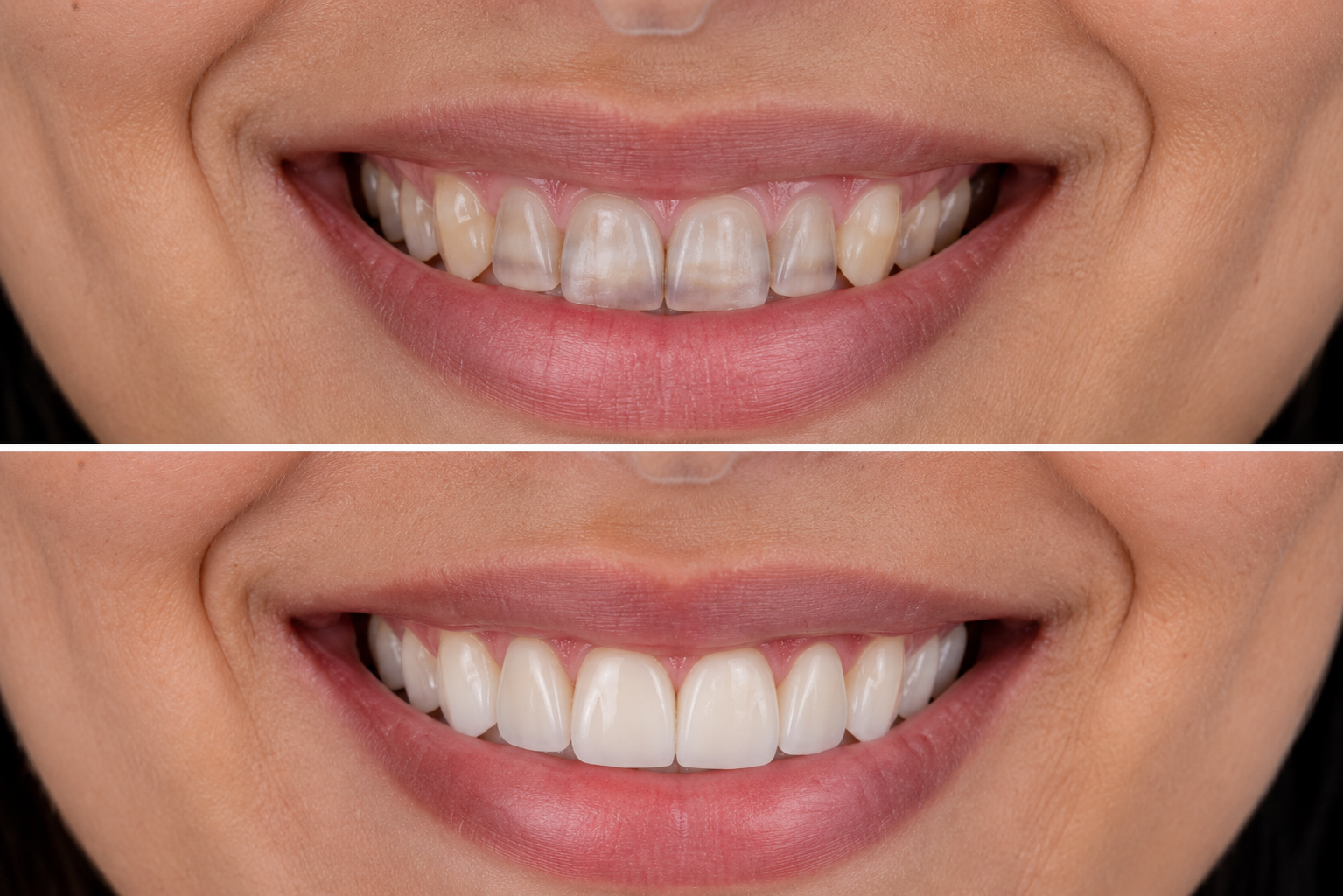 Dental veneers consultation in Karachi