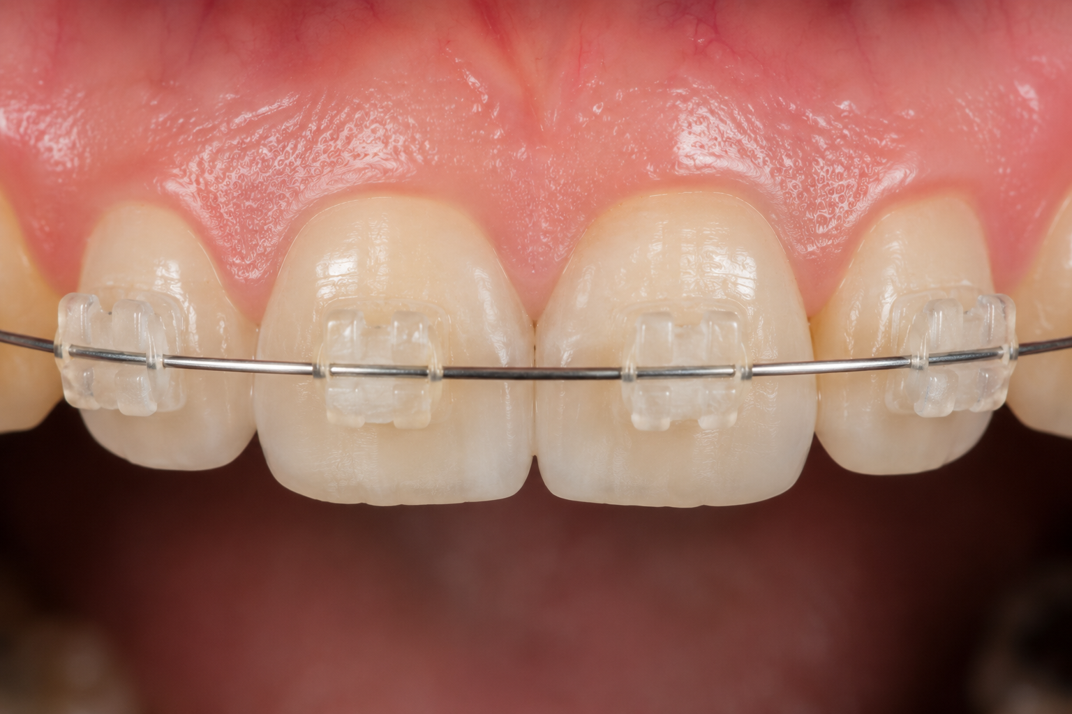 Ceramic braces treatment at FG Cosmo Dental Clinic Karachi