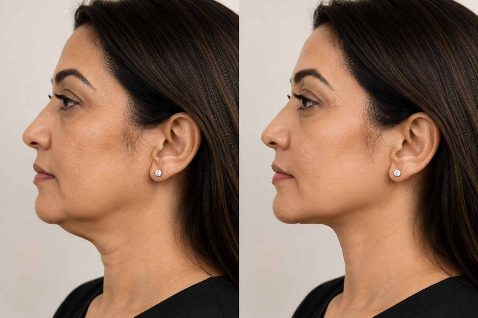 Non-surgical HIFU consultation at FG Cosmo Dental Clinic Karachi