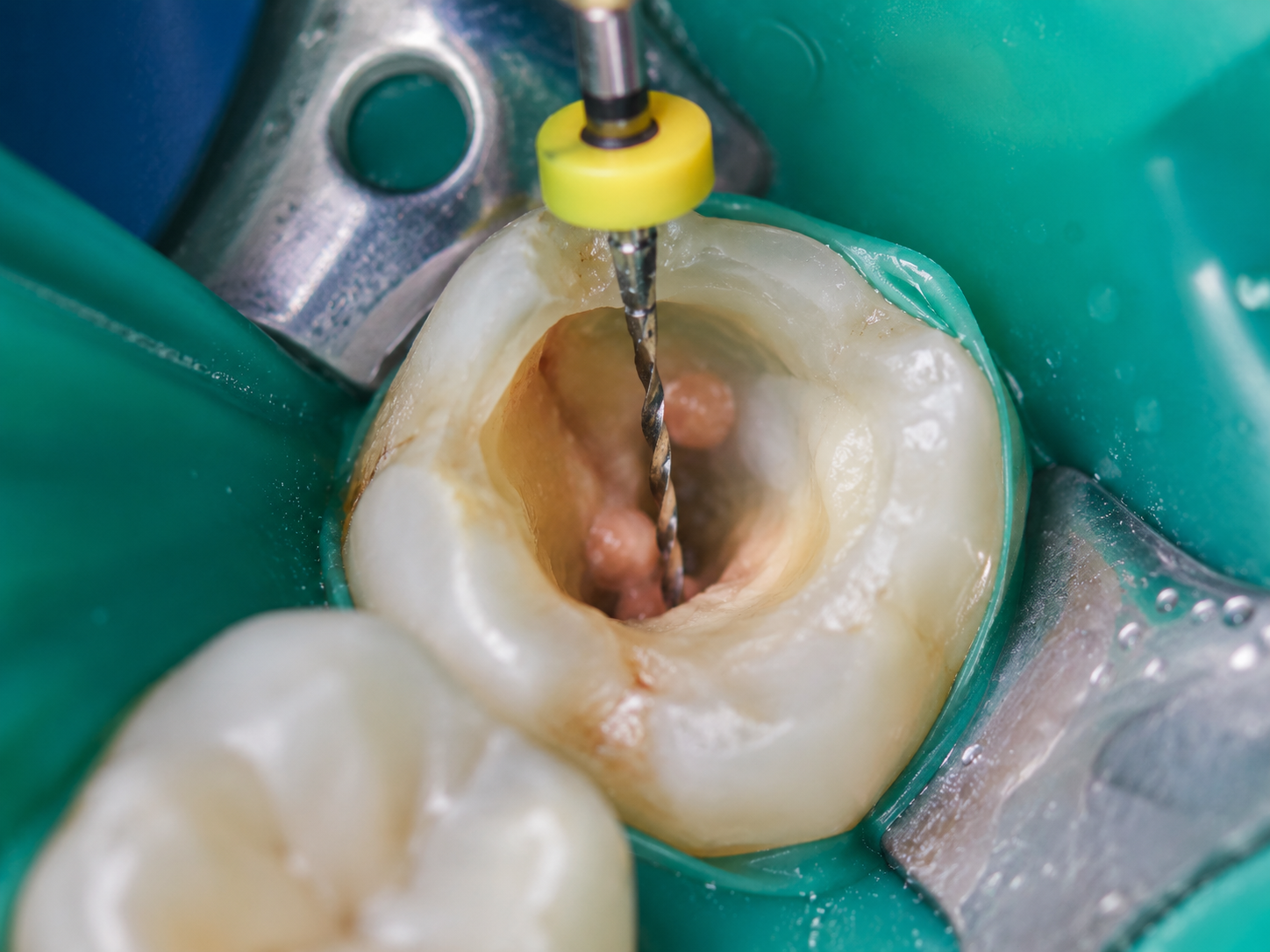Root canal treatment close-up at FG Cosmo Dental Clinic Karachi