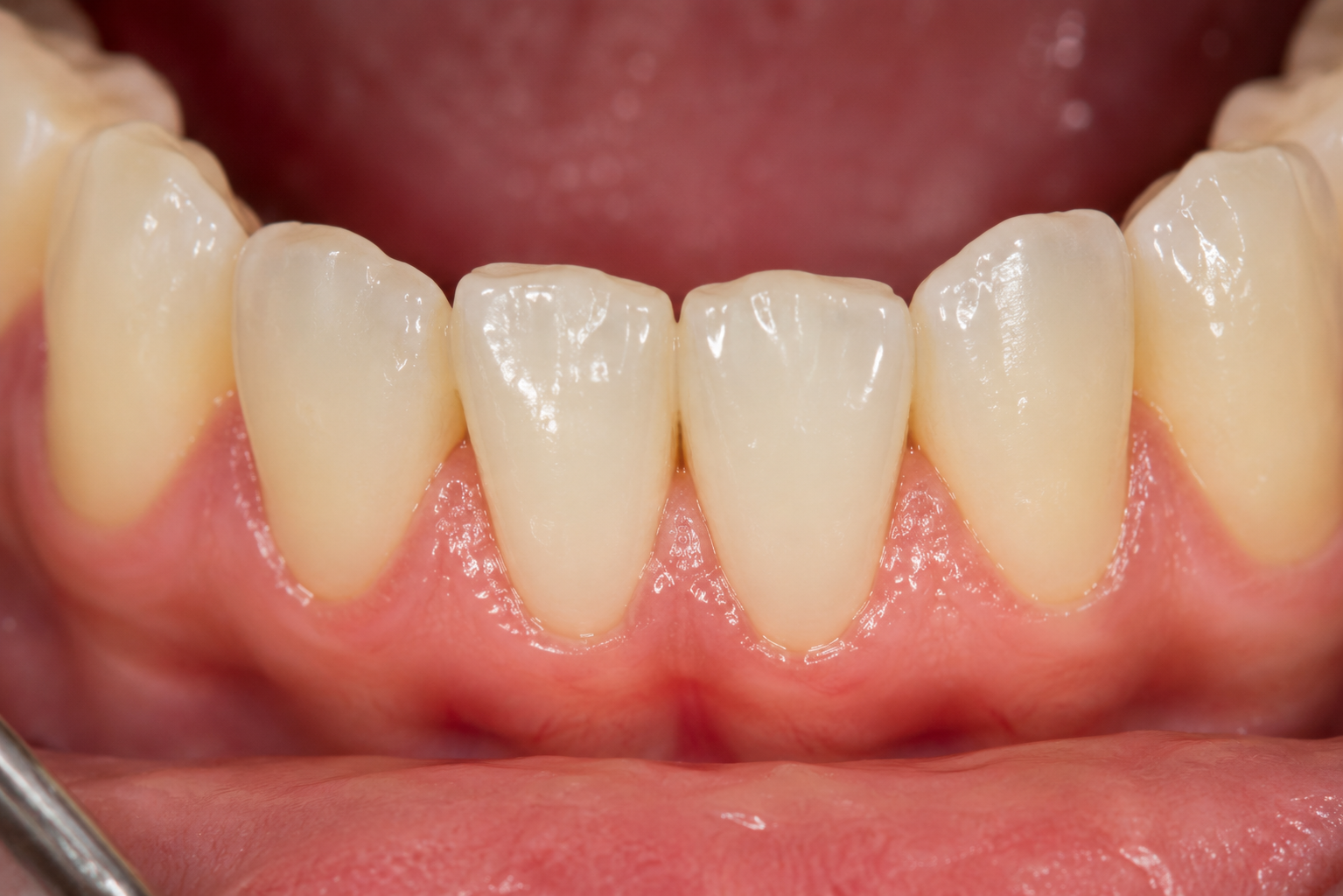 Professional scaling and teeth cleaning in Karachi
